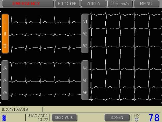 Вывод кардиологических параметров на экран кардиографа Cardisuny C-320