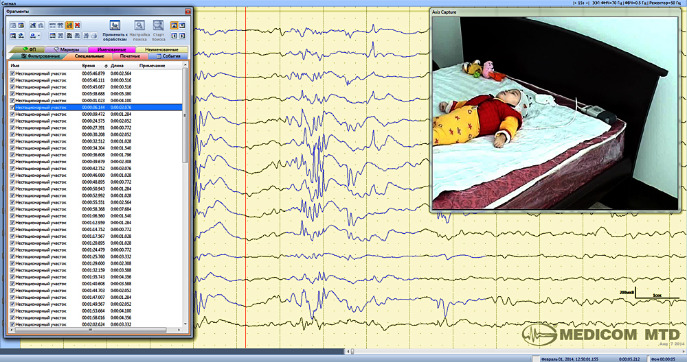 Ээг видеомониторинг сна. ЭЭГ видеомониторинг. Видеомониторинг ЭЭГ при эпилепсии. Ночное видео ЭЭГ мониторинг.