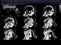 Плод, лицо, Multi OVIX, режим прозрачности X-ray, 3D