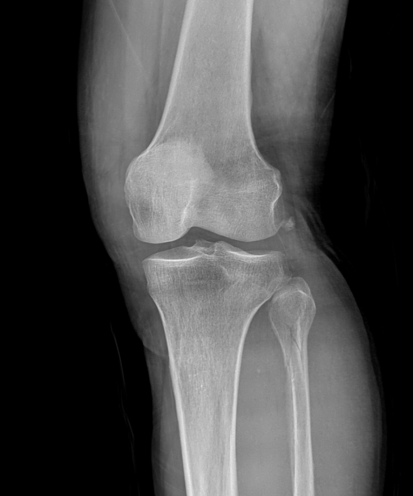 x-ray_img_dixion_knee.jpg